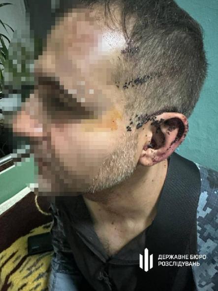 На Одещині військовий потрапив у лікарню після побиття у військовій частині