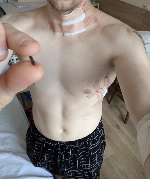 “Зі мною знову сталося диво”: журналіст Станіслав Асєєв отримав поранення 